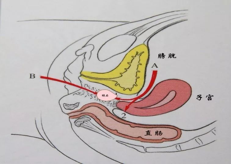 石女手术 如图所示图片