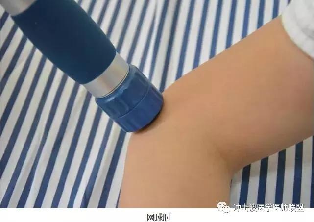 eswt体外冲击疗疗法治疗网球肘效果神奇