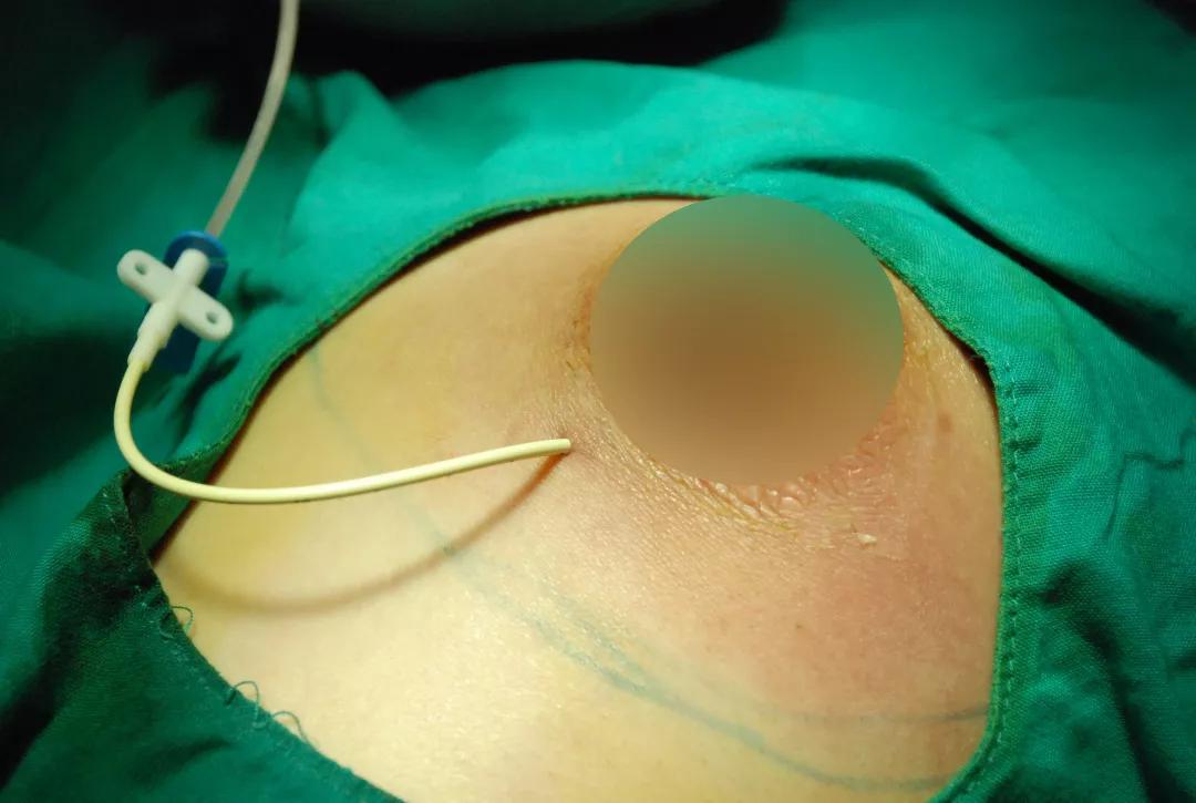 乳房手术全过程 引流图片