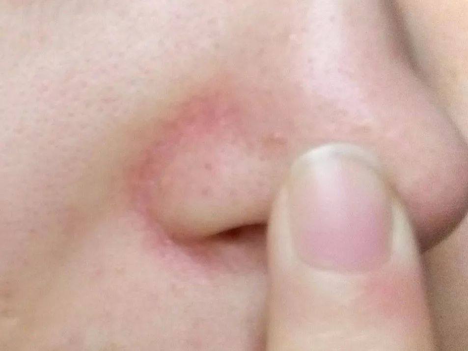 鼻子两边脂溢性皮炎图图片