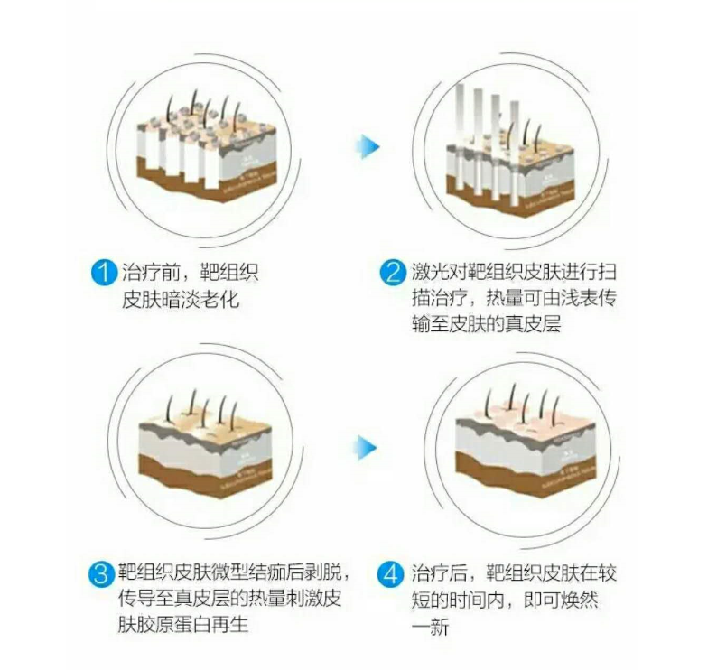 而近几年临床应用较多的激光超脉冲co2点阵激光,波长10600nm,属于剥脱