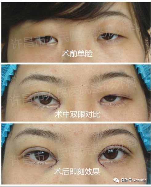 双眼皮术后如何避免疤痕肉条水肿