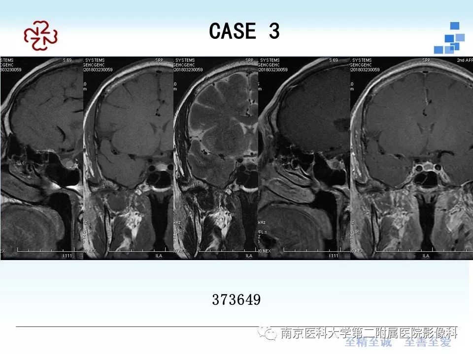 史上最全垂体rathke囊肿的mri诊断与鉴别
