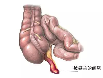 吴彦祖真的是盲肠炎穿孔吗医生却说不是