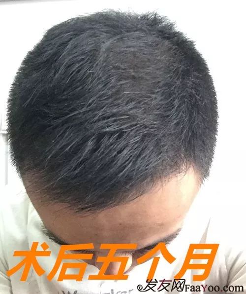 植发手术后吃醋(植完发能吃醋吗?)