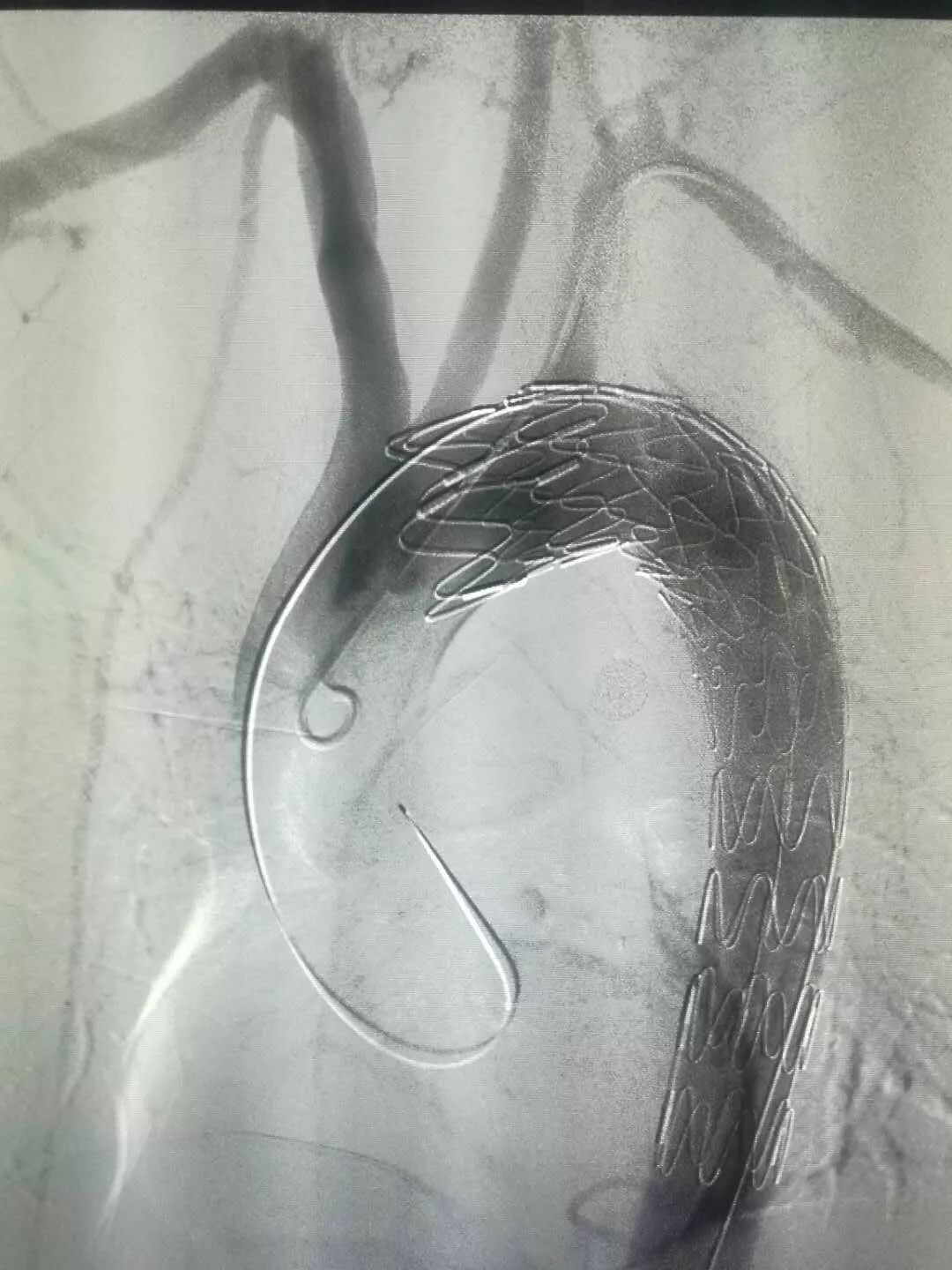 胸主动脉瘤介入支架图片