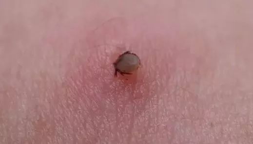 惊!11岁男孩被黑虫叮咬,母亲发现他伤口处竟有蠕动的