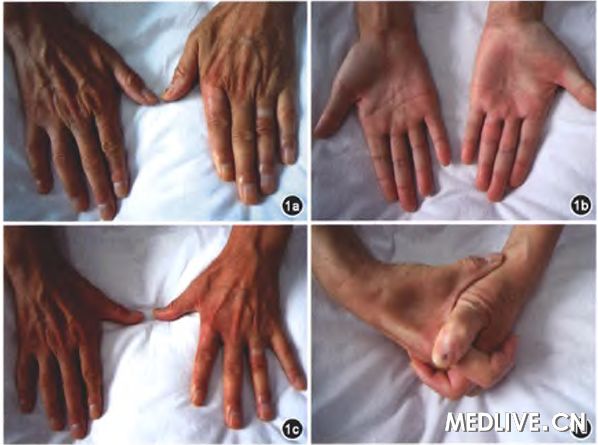 有没有糖尿病看自己的手就能知道有4个手部状况是糖尿病前兆