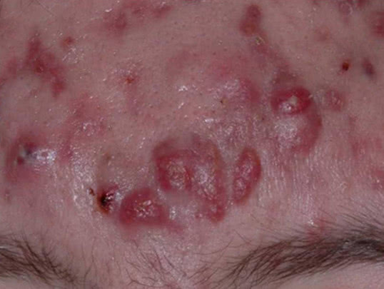 黑头粉刺痘痘都叫痤疮痤疮到底是个啥