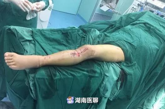 突遇车祸七旬大爷整条左腿骨折变形高龄手术风险怎么避