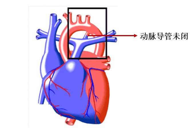 动脉导管的位置图片