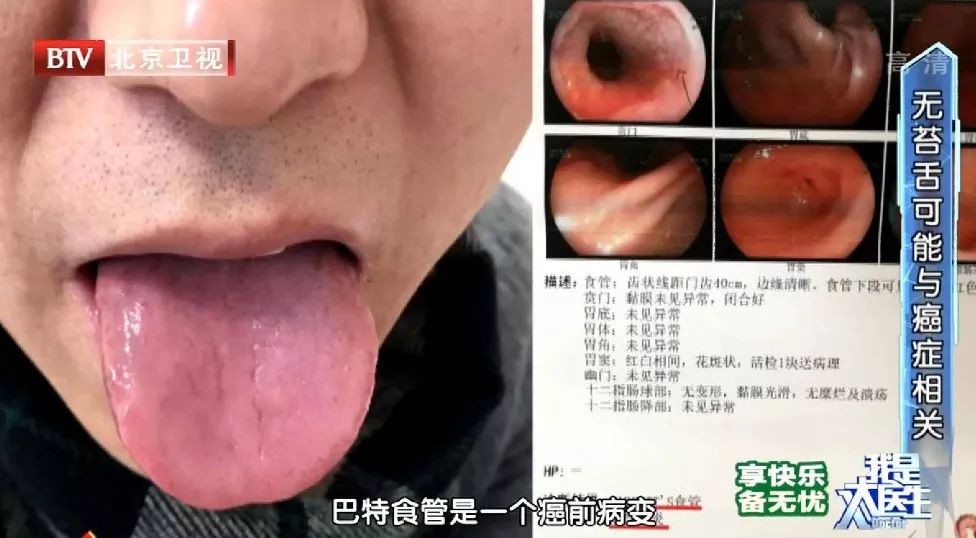 健康有这3种舌象当心癌症找上门舌头与癌症有这样的关系