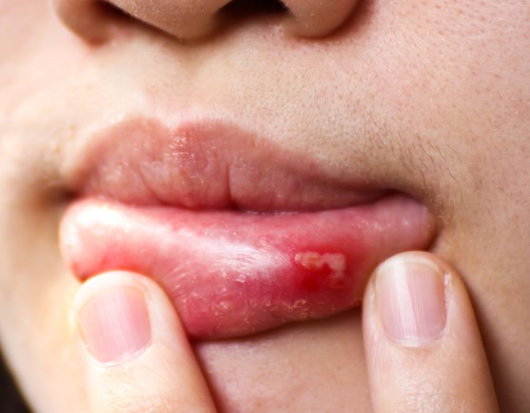 口腔溃疡的4个因素别忽视长期不好谨防3种疾病