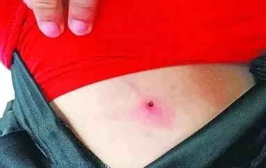 惊!11岁男孩被黑虫叮咬,母亲发现他伤口处竟有蠕动的