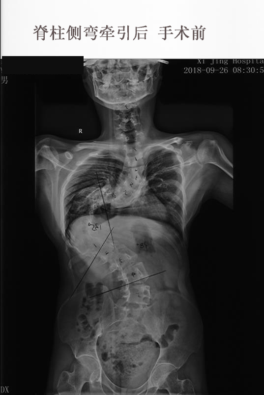 重度脊柱侧弯术前舒适高效的halo头环牵引技术问答