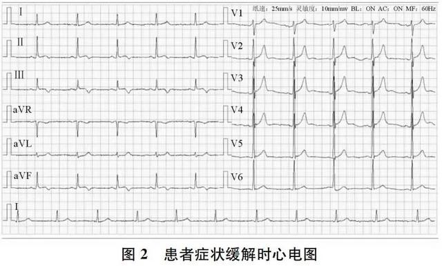 心血管专题变异型心绞痛发作时心电图酷似dewinterstt改变1例