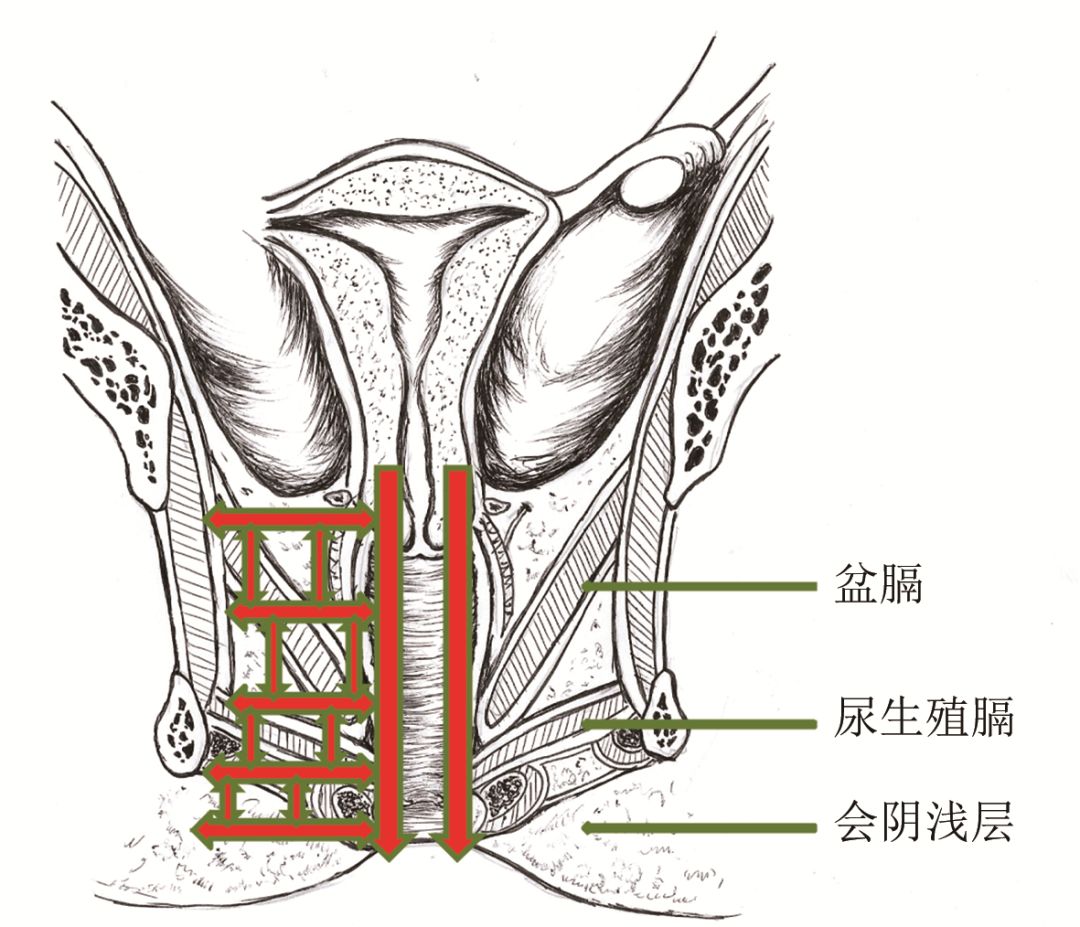 尿道肉阜手术步骤图片图片