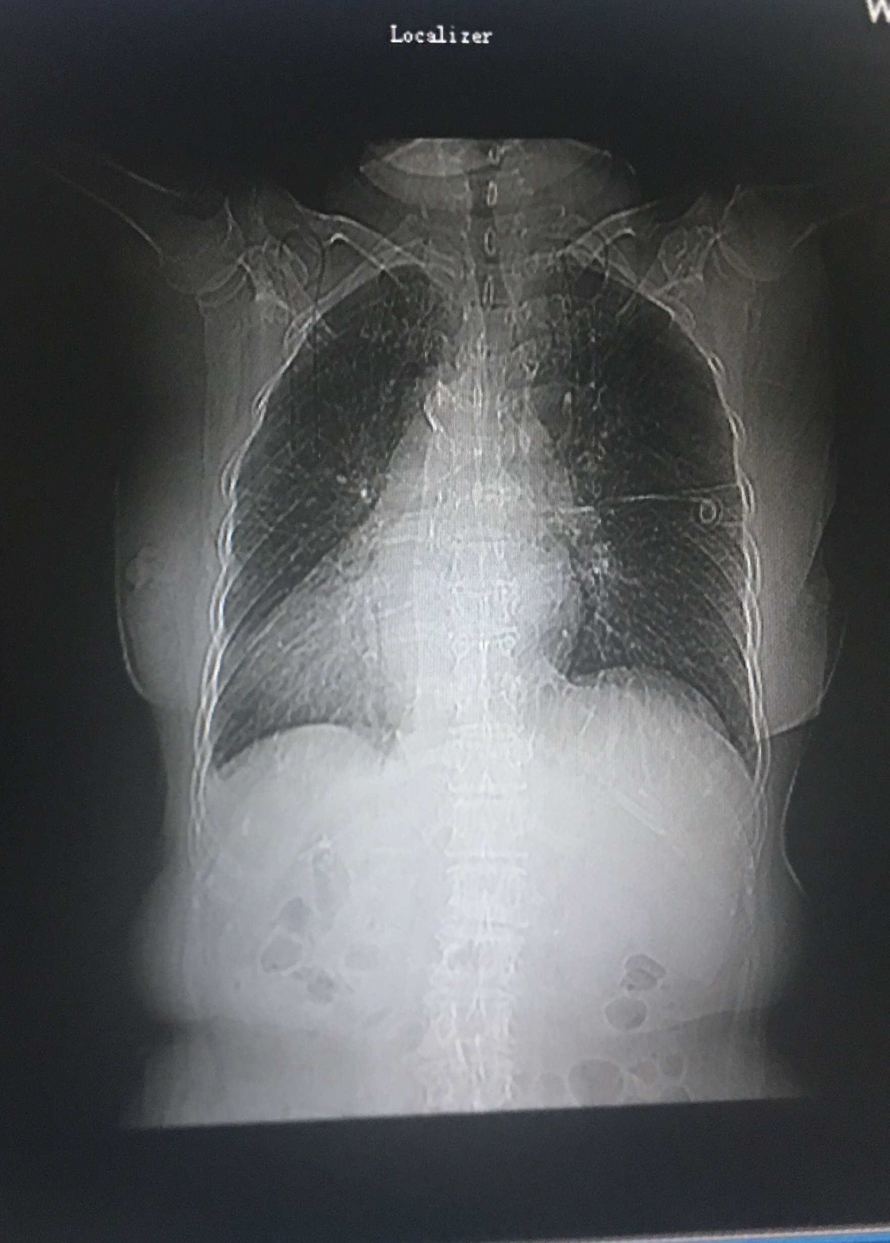 认识"内脏反位" (原创)_患者