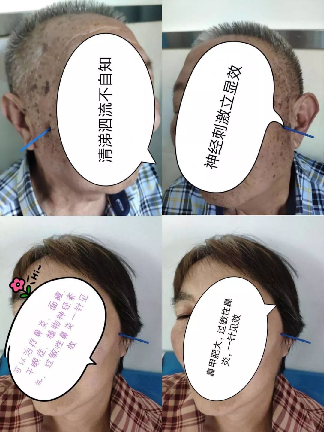 健康的福音鼻炎的克星蝶腭神经节针刺术