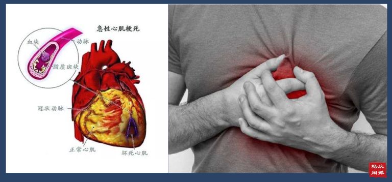 救命的心脏支架是神话还是谎话