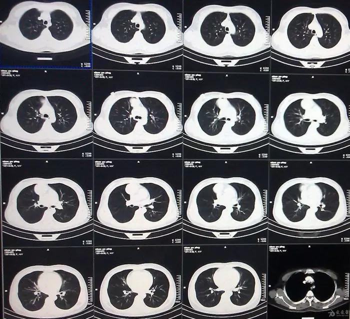 正常肺CT图片与病变CT图片