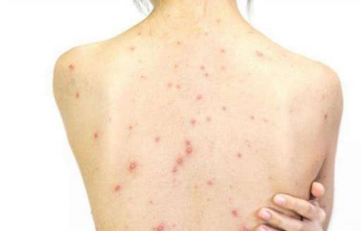 脸上不长痘痘后背全是痘痘的人多半离不开这4大原因