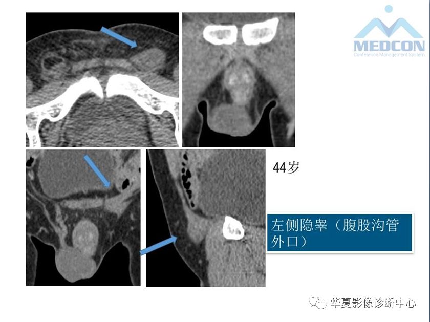 阴囊内病变的影像诊断