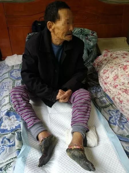 这位老汉需要截肢只因为50年做了这样一件事
