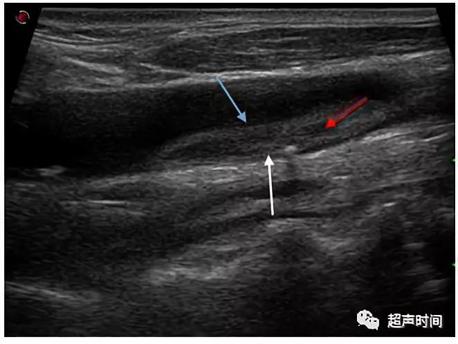 颈动脉斑块超声图片图片