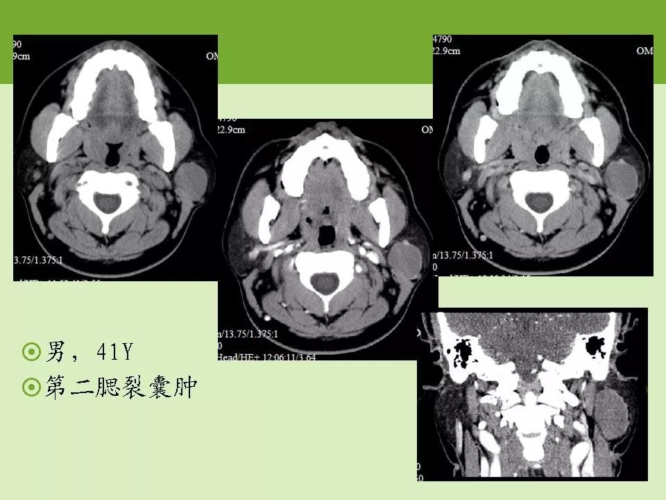 腮腺解剖结构图CT图片