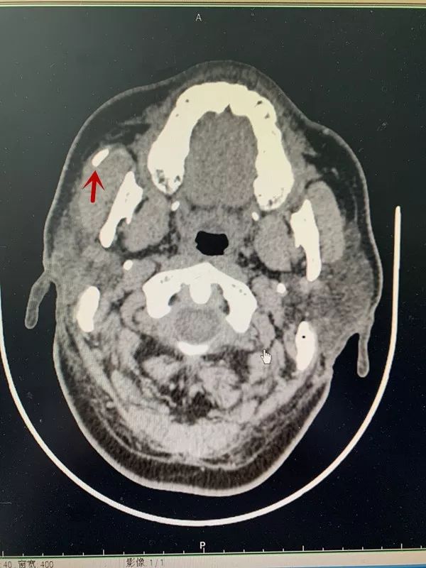 腮腺导管结石ct图片图片