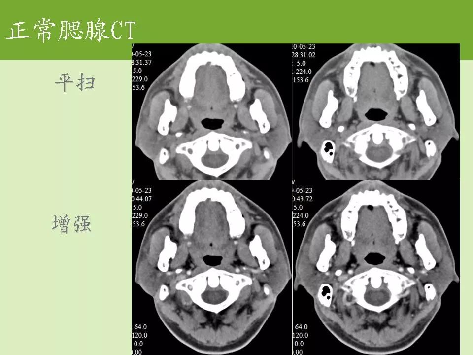 腮腺解剖结构图CT图片