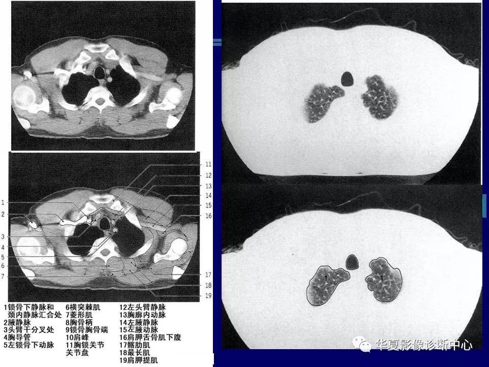 胸部ct解剖