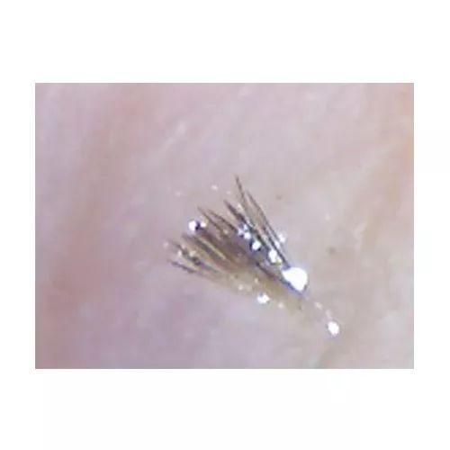 显微镜下的黑头粉刺图片