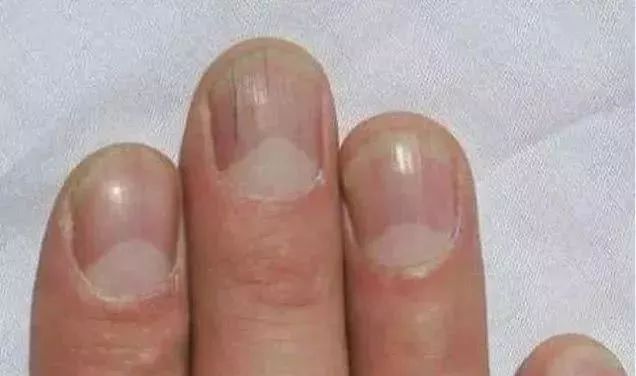 竖个中指测测肝一旦发现存在三个迹象可能是肝脏将硬化