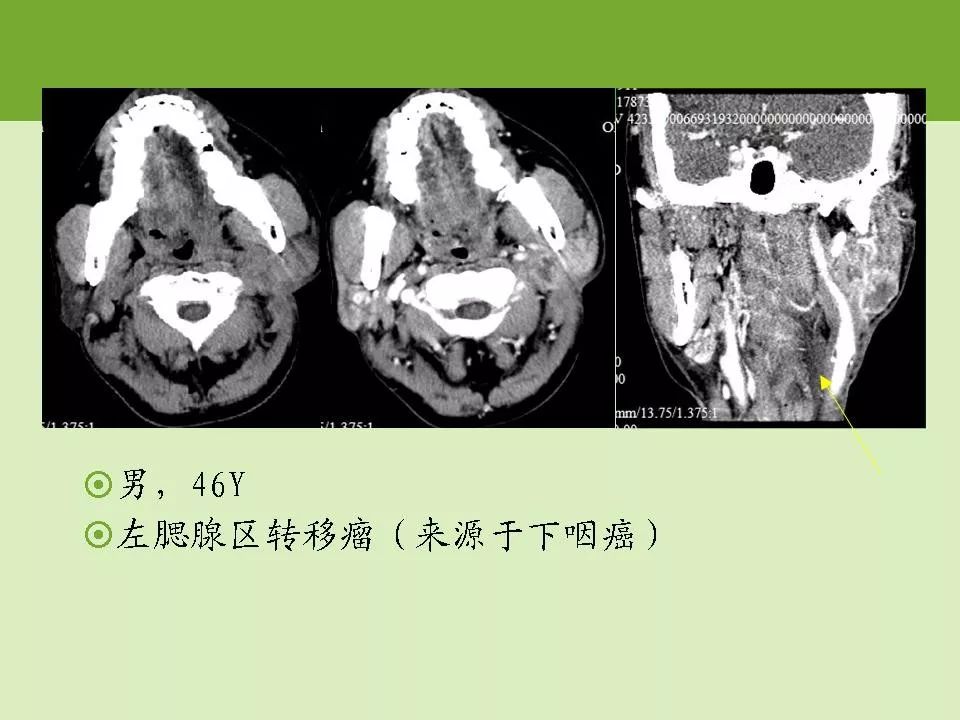 腮腺区常见病变的ct鉴别诊断影像天地