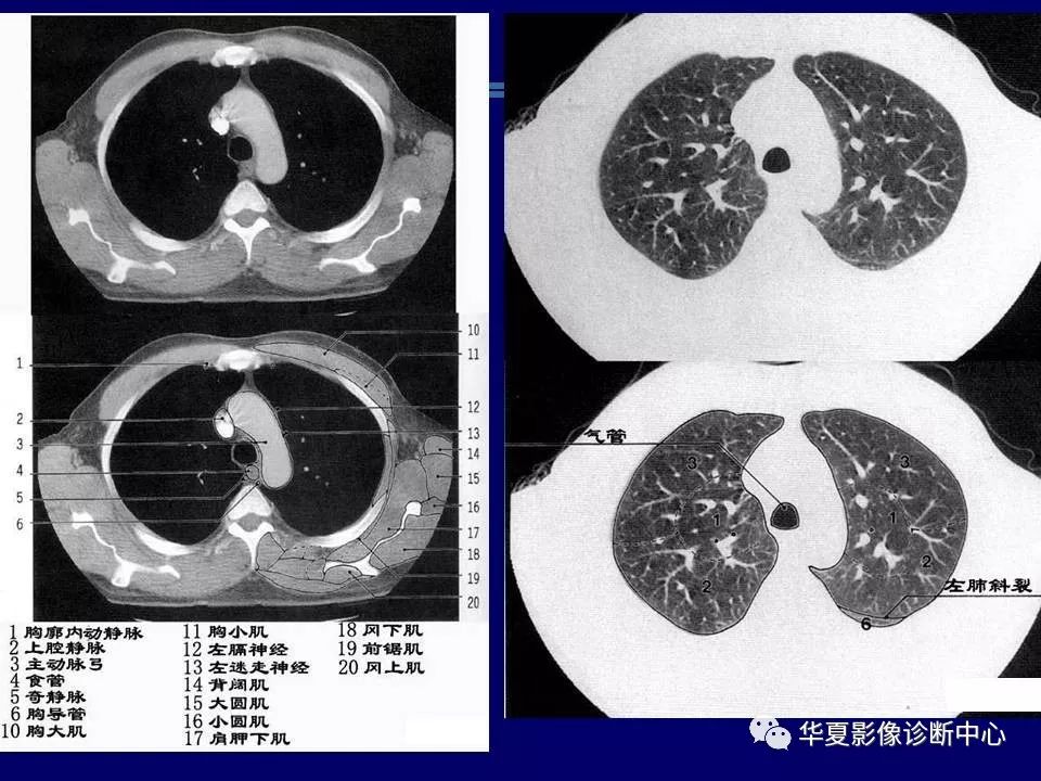 胸部ct解剖