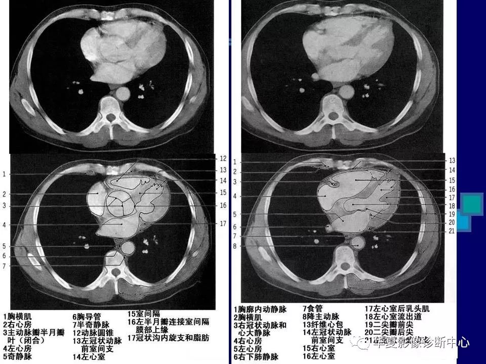 胸部ct解剖