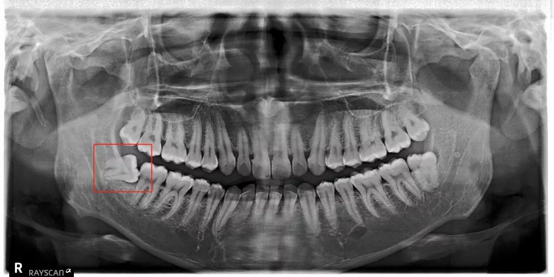 对智齿仁慈就是对自己残忍