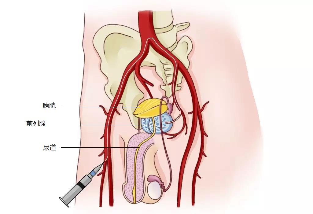 前列腺动脉栓塞术仅需在大腿根部股动脉取一个"小针口",置入不到2mm微