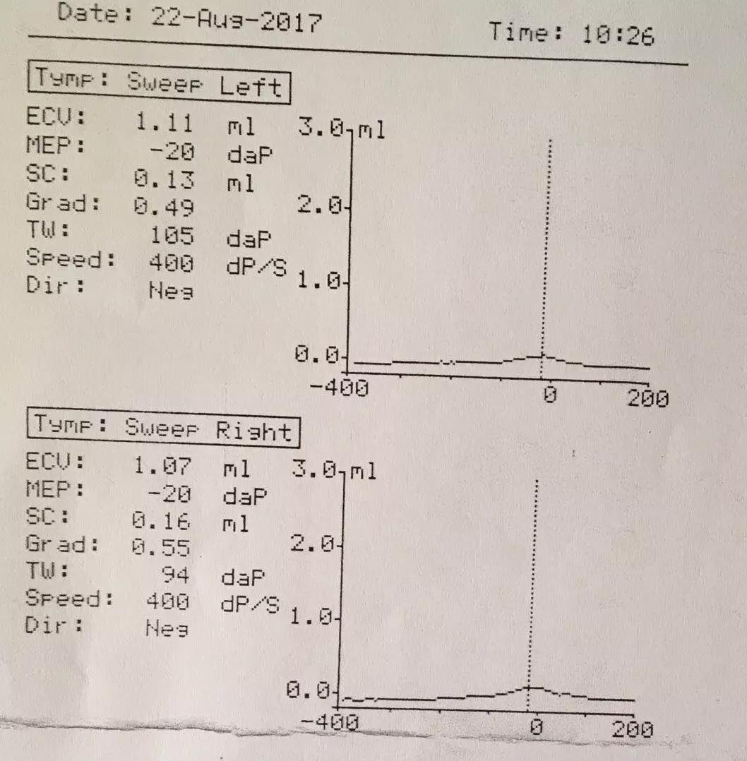 上图显示双耳声阻抗鼓室图为as型.