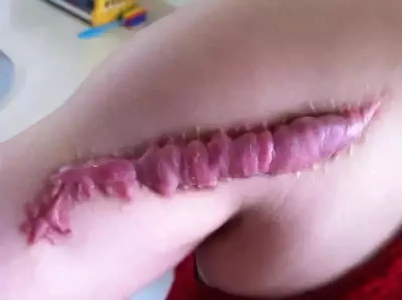 评价:根据我实践经验,单纯使用三七粉效果一般,建议配合外科手术治疗