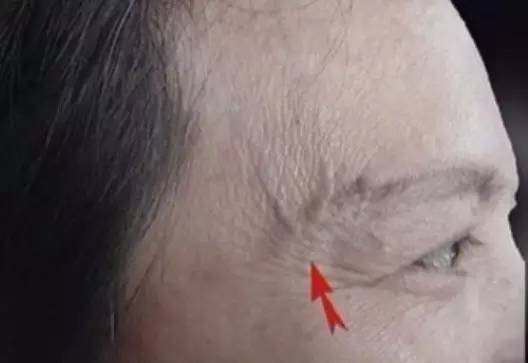 身体这里有青筋竟是中风心脏病肝病前兆可惜没几个人真正知道的