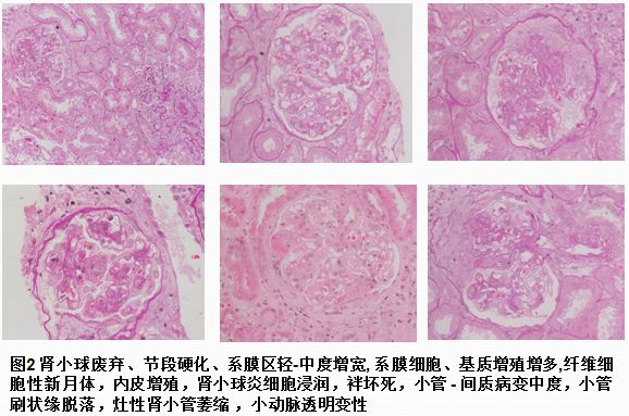 電鏡光鏡下22 個腎小球 , 其中 3個腎小球球性廢棄 ,球囊內可見纖維素