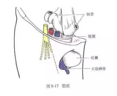 大腿根部卵圆窝解剖图图片