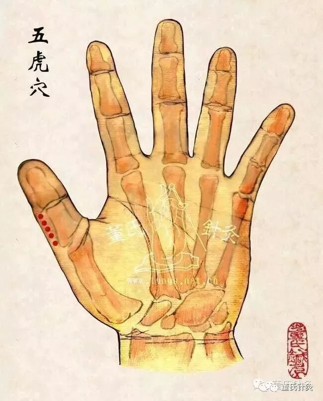 董氏针灸林正泰案例分享之五虎穴