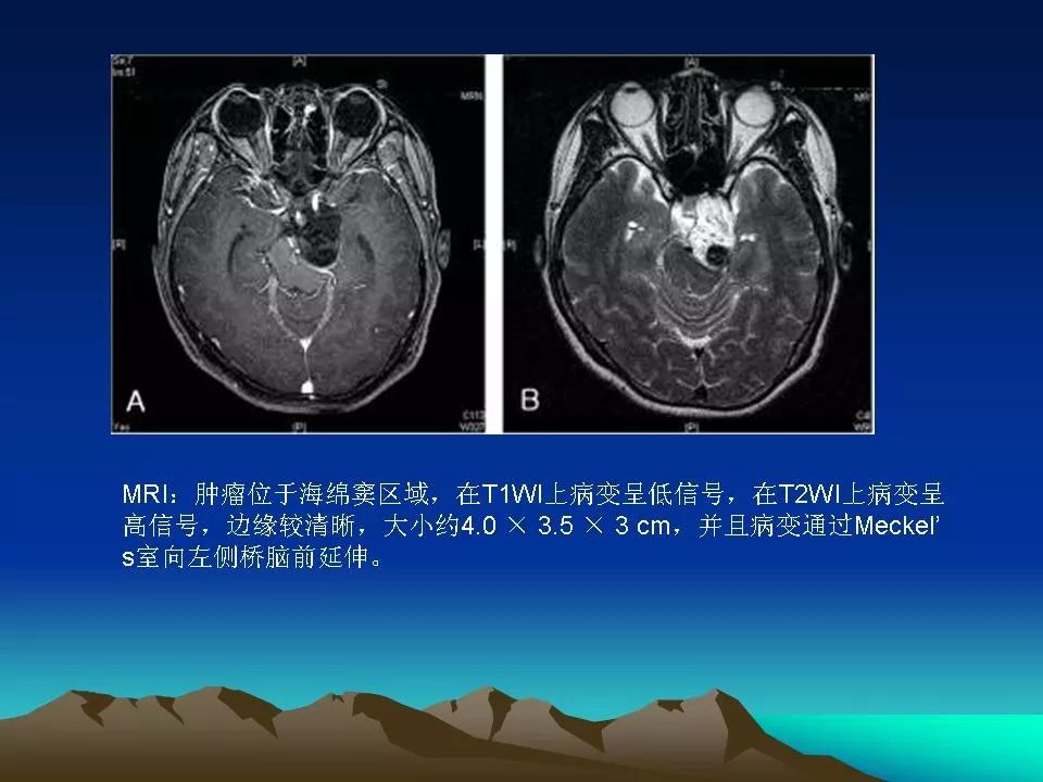 表皮样囊肿和皮样囊肿影像天地