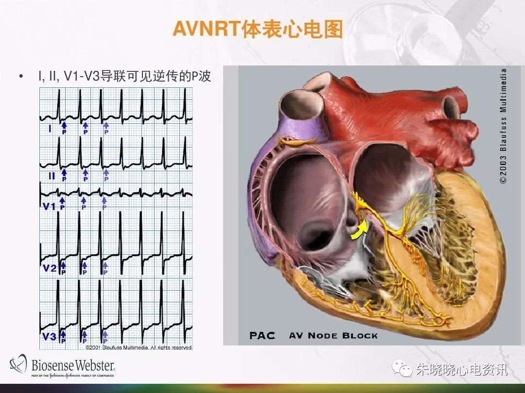 6月6日 中国房颤日】射频消融术介绍_导管