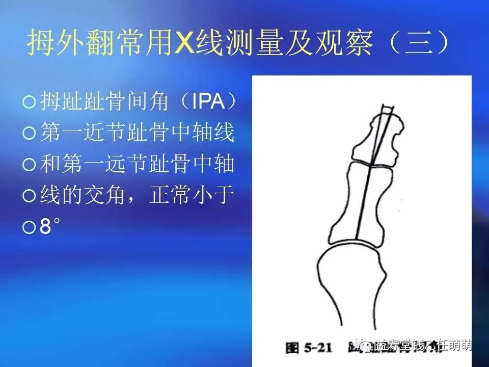 拇外翻的临床表现与检查