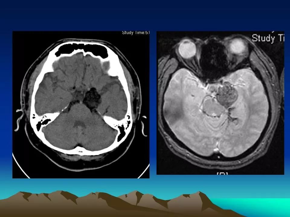 表皮样囊肿和皮样囊肿影像天地